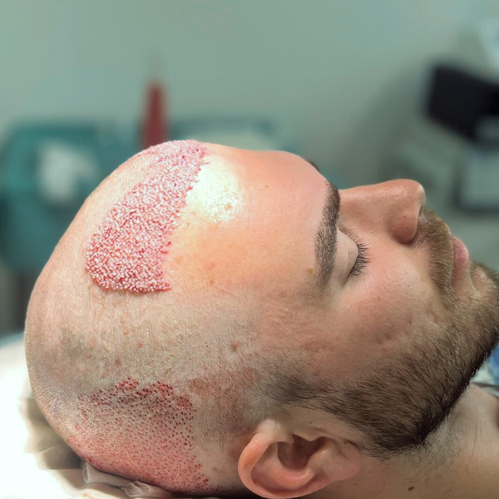 FUE Haartransplantation